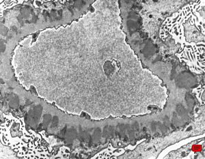  M,60y. | membranous glomerulopathy